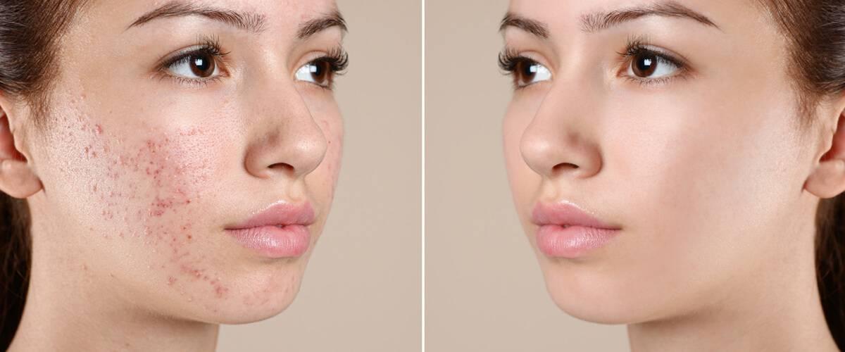 SİVİLCE - AKNE - LEKE BAKIMI