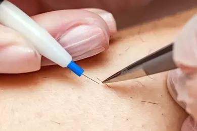 İĞNELİ EPİLASYON